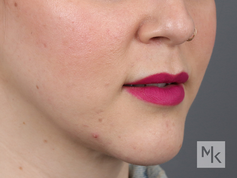 Lip Lift Before and After | Dr. Michael Kim