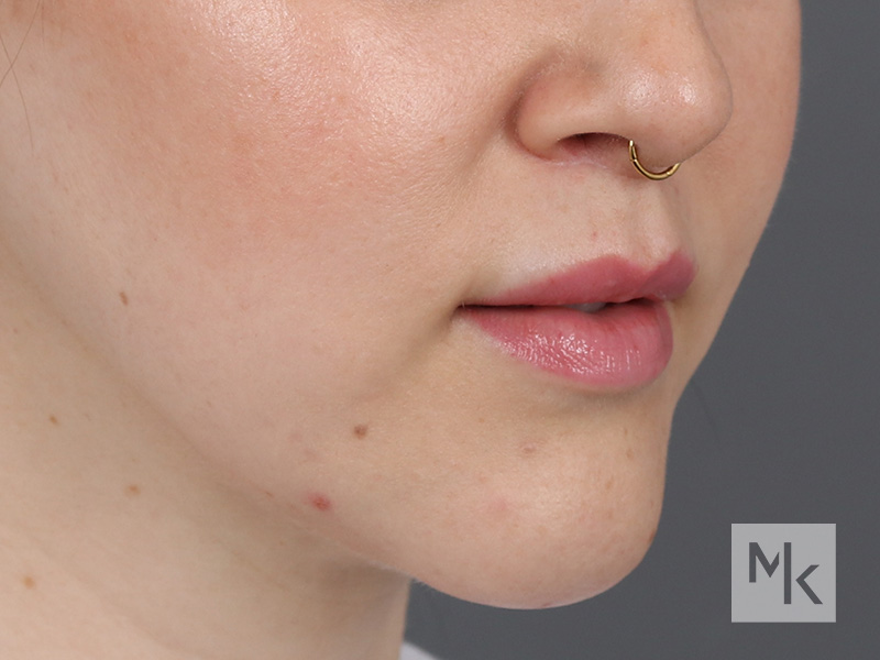 Lip Lift Before and After | Dr. Michael Kim