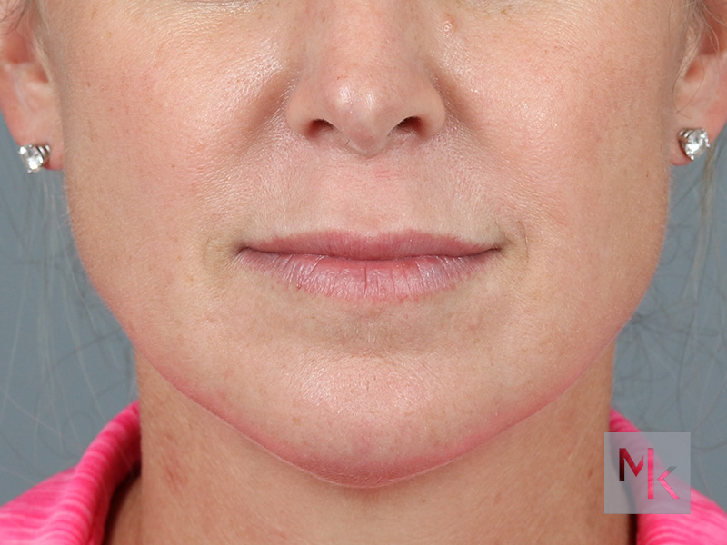 Lip Lift Before and After | Dr. Michael Kim