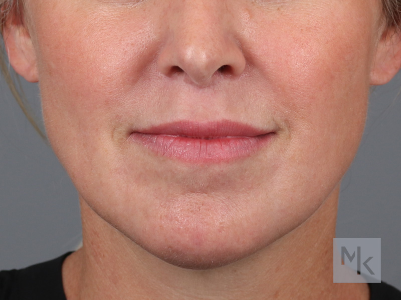 Lip Lift Before and After | Dr. Michael Kim