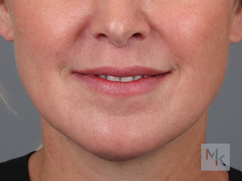 Lip Lift Before and After | Dr. Michael Kim