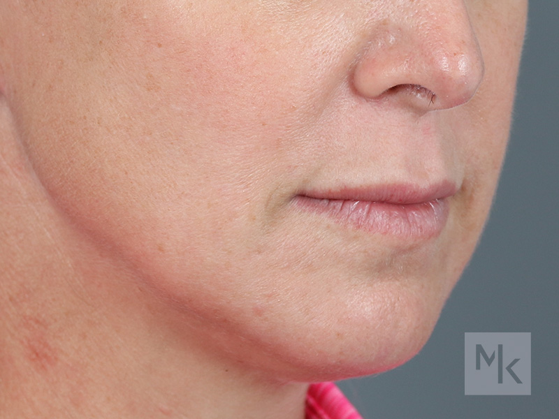 Lip Lift Before and After | Dr. Michael Kim