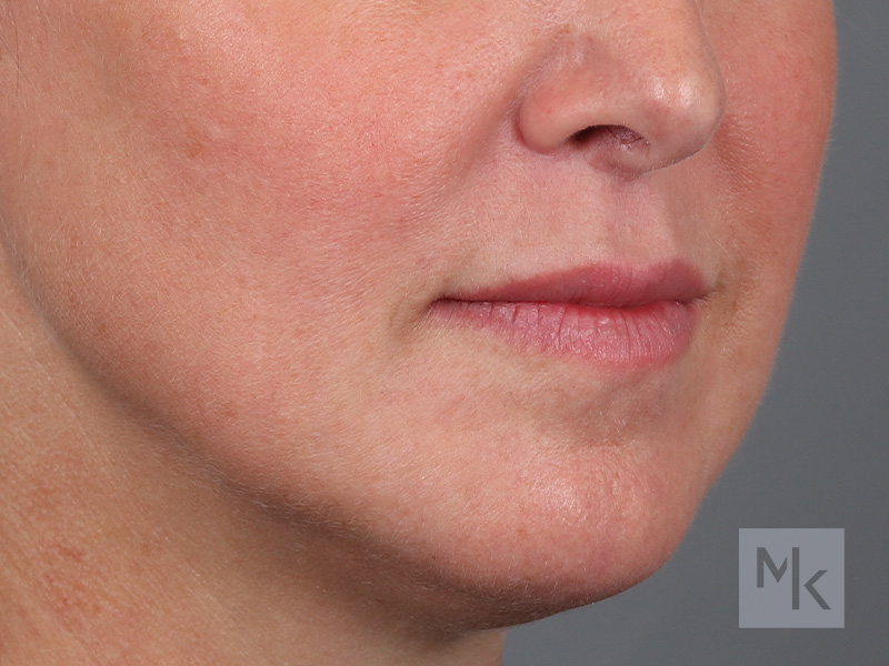 Lip Lift Before and After | Dr. Michael Kim