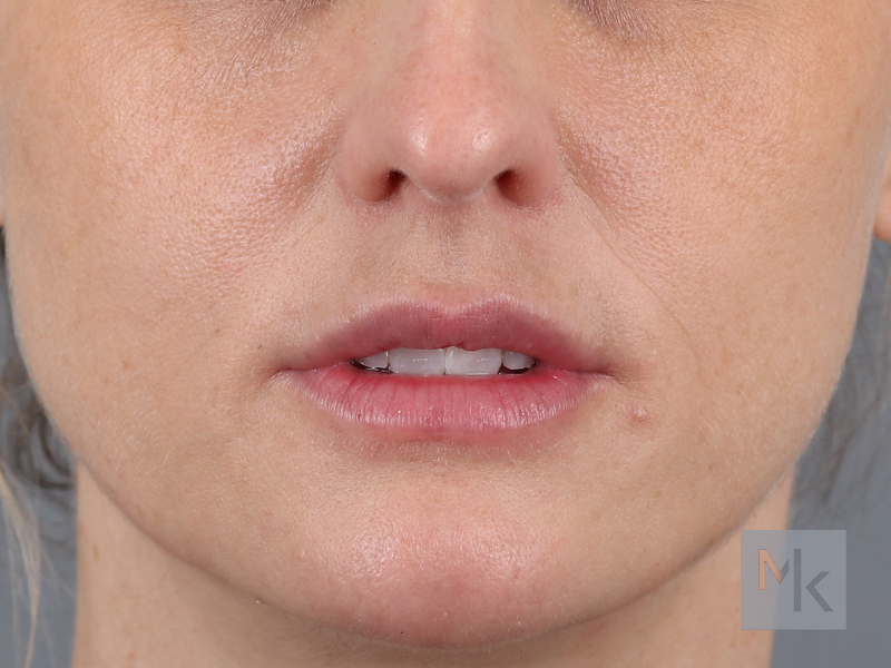 Lip Lift Before and After | Dr. Michael Kim