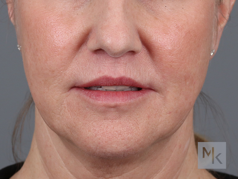 Lip Lift Before and After | Dr. Michael Kim