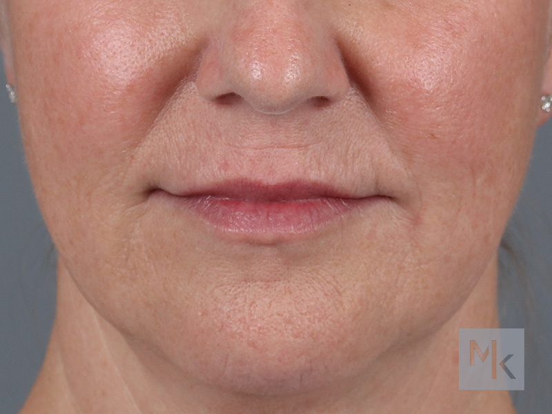 Lip Lift Before and After | Dr. Michael Kim