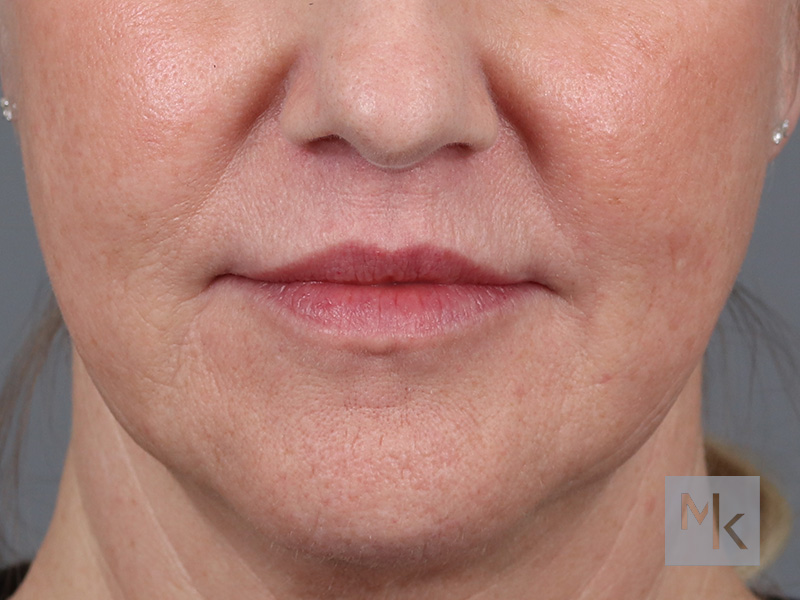 Lip Lift Before and After | Dr. Michael Kim