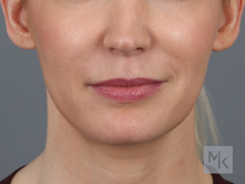 Lip Lift Before and After | Dr. Michael Kim