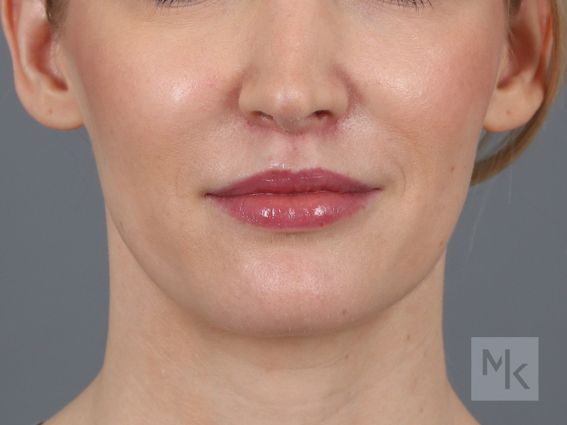 Lip Lift Before and After | Dr. Michael Kim