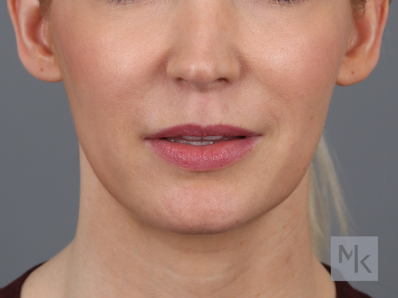 Lip Lift Before and After | Dr. Michael Kim