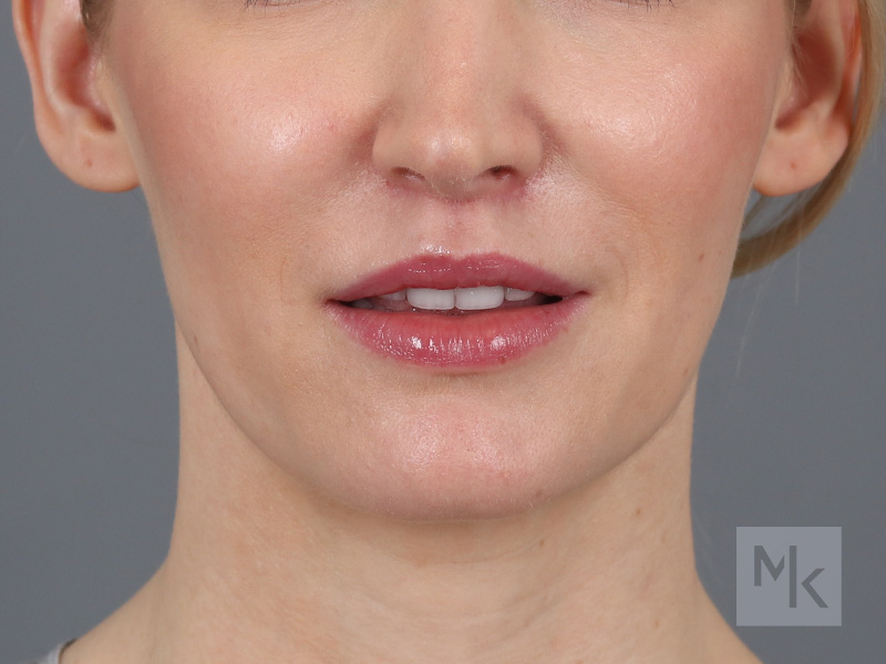 Lip Lift Before and After | Dr. Michael Kim