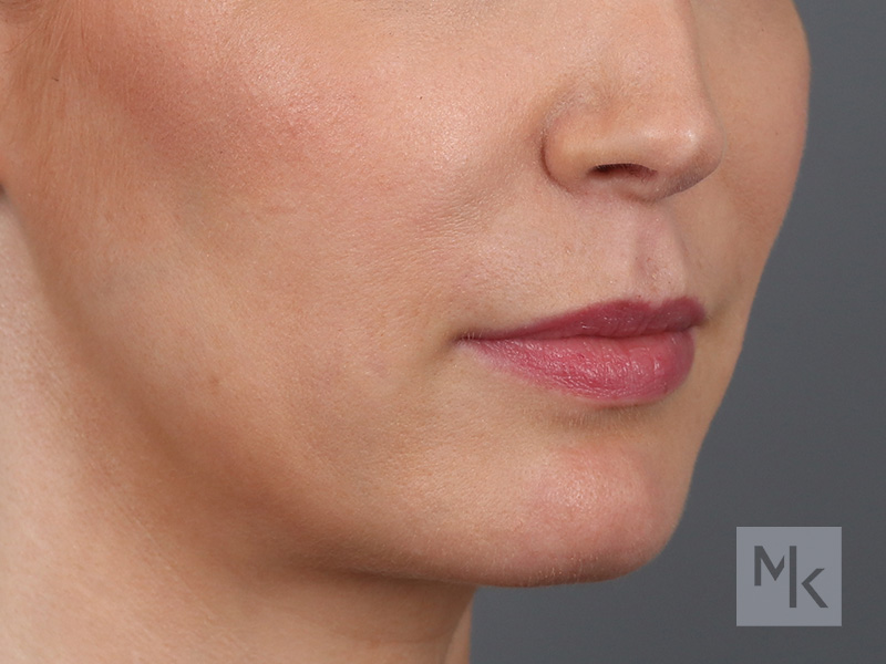 Lip Lift Before and After | Dr. Michael Kim