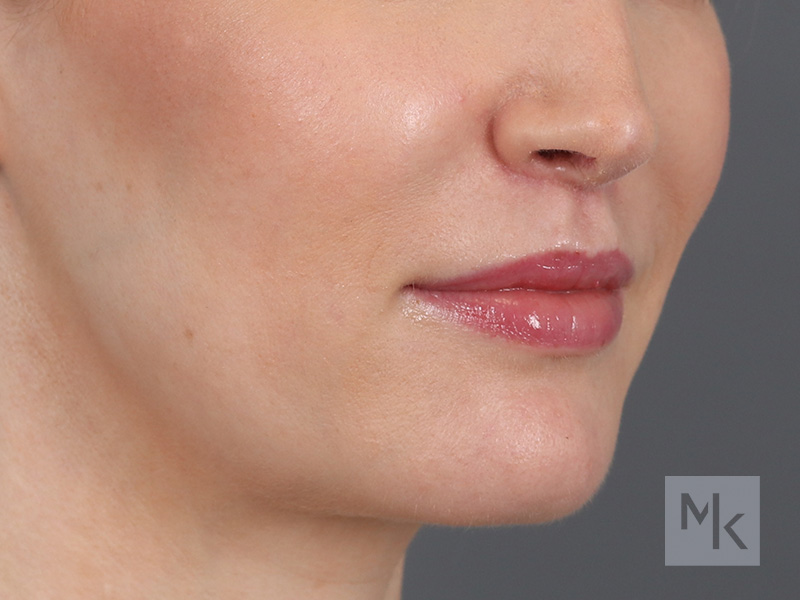 Lip Lift Before and After | Dr. Michael Kim