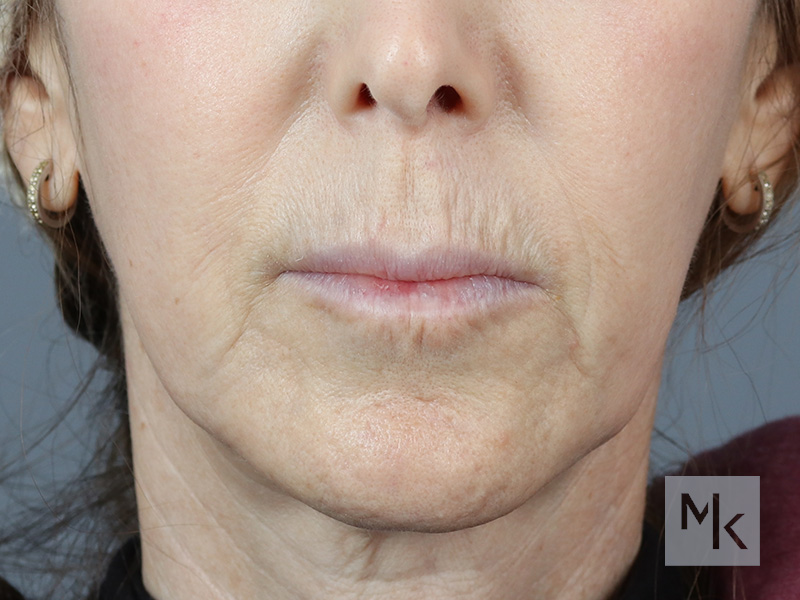 Lip Lift Before and After | Dr. Michael Kim