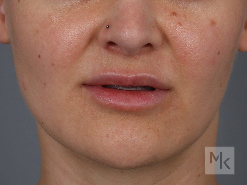 Lip Lift Before and After | Dr. Michael Kim