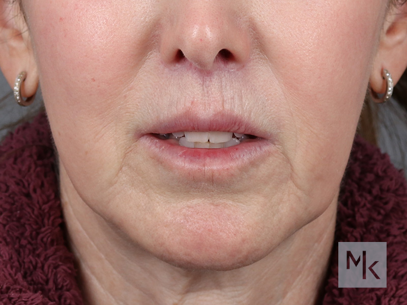 Lip Lift Before and After | Dr. Michael Kim