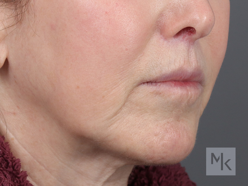 Lip Lift Before and After | Dr. Michael Kim