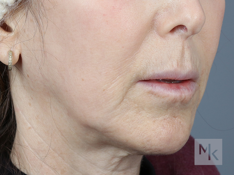 Lip Lift Before and After | Dr. Michael Kim