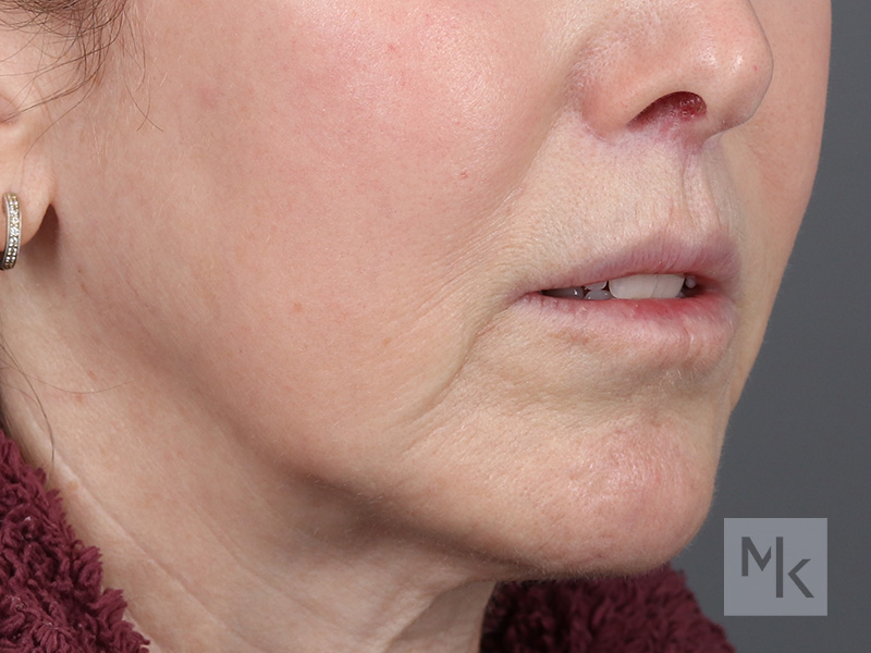 Lip Lift Before and After | Dr. Michael Kim