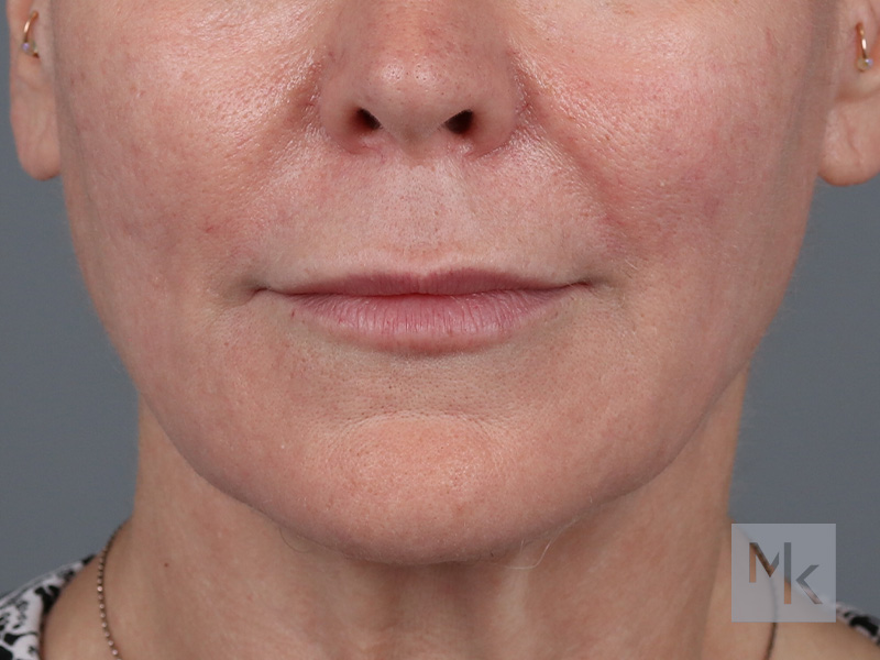 Lip Lift Before and After | Dr. Michael Kim