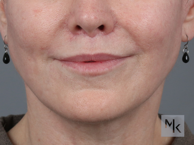 Lip Lift Before and After | Dr. Michael Kim