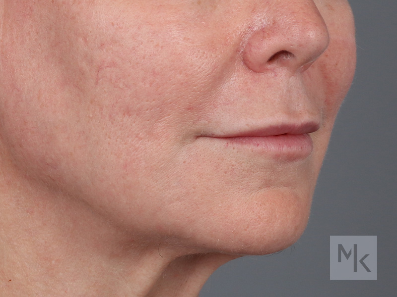 Lip Lift Before and After | Dr. Michael Kim
