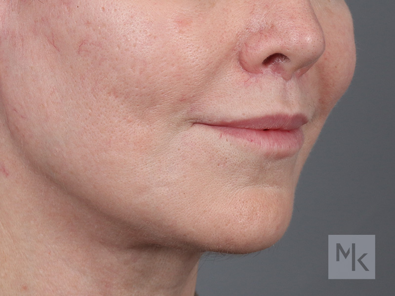 Lip Lift Before and After | Dr. Michael Kim