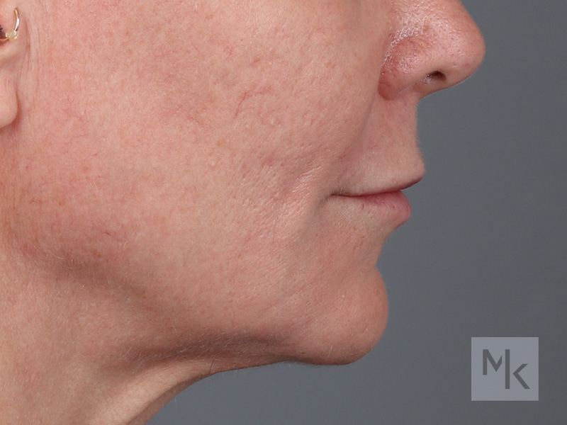 Lip Lift Before and After | Dr. Michael Kim