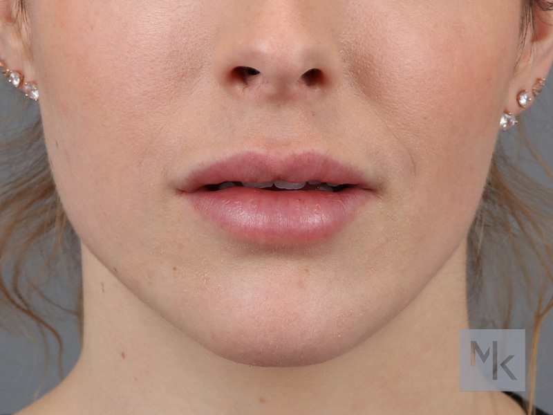 Lip Lift Before and After | Dr. Michael Kim