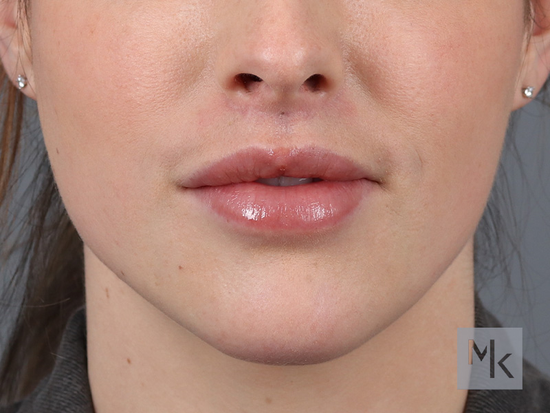 Lip Lift Before and After | Dr. Michael Kim
