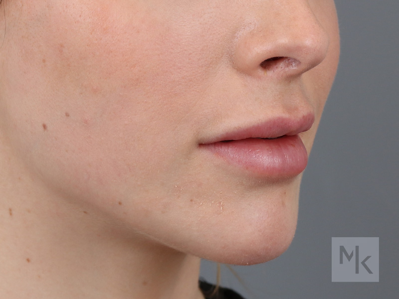 Lip Lift Before and After | Dr. Michael Kim