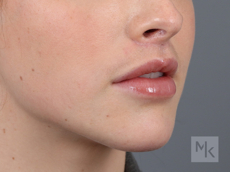 Lip Lift Before and After | Dr. Michael Kim
