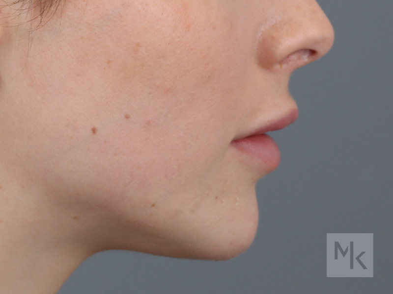Lip Lift Before and After | Dr. Michael Kim