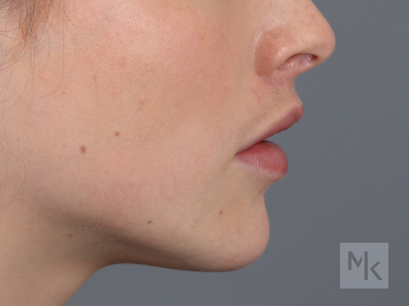 Lip Lift Before and After | Dr. Michael Kim