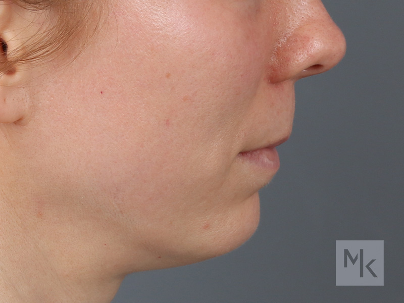 Lip Lift Before and After | Dr. Michael Kim