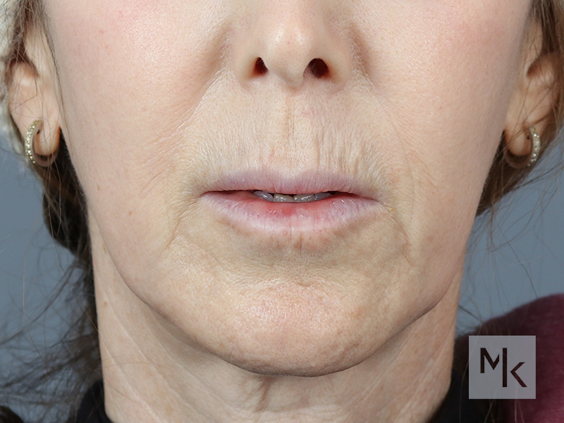 Lip Lift Before and After | Dr. Michael Kim