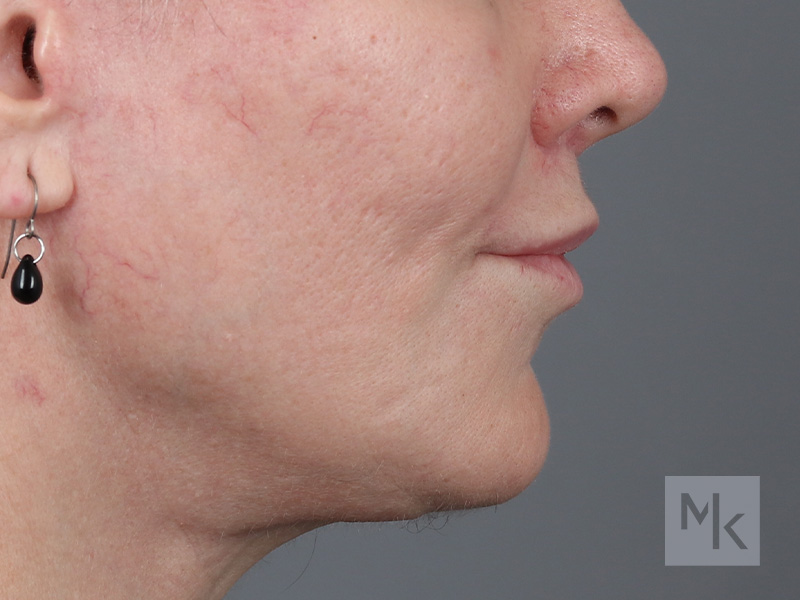 Lip Lift Before and After | Dr. Michael Kim