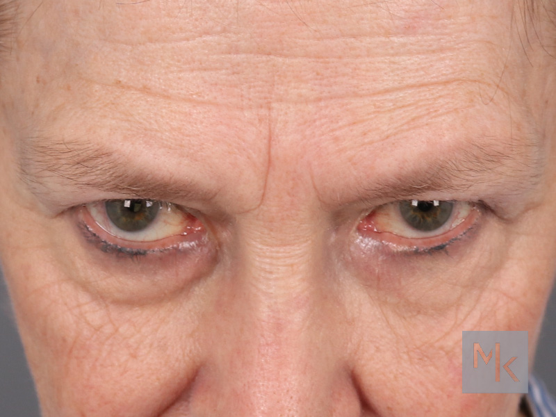 Lower Blepharoplasty Before and After | Dr. Michael Kim