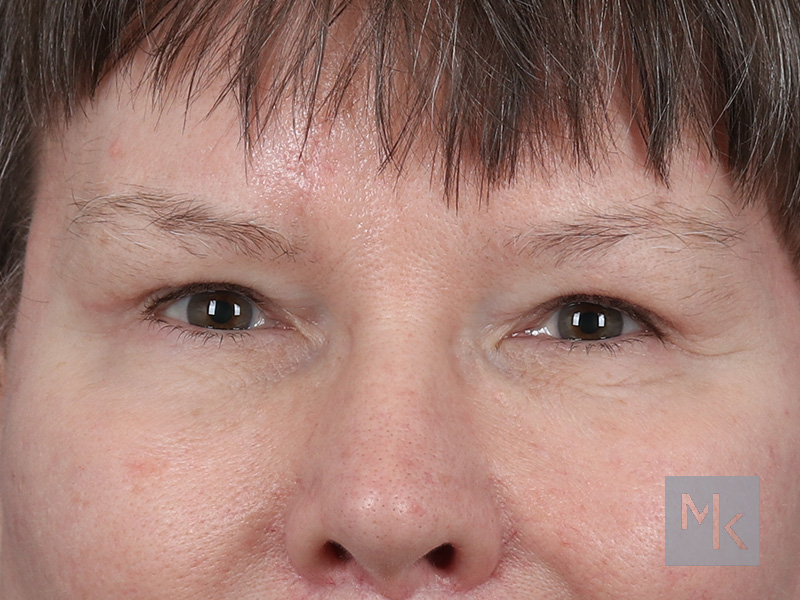 Lower Blepharoplasty Before and After | Dr. Michael Kim