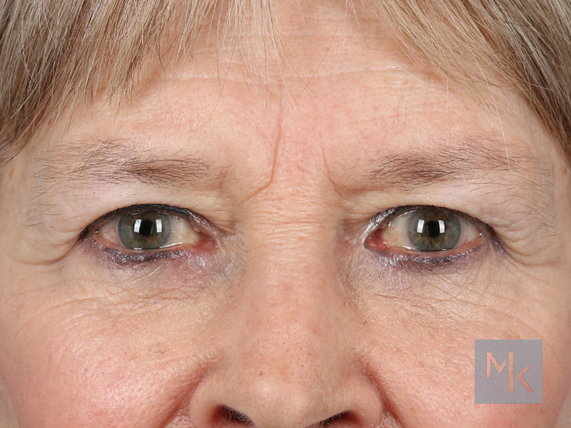 Lower Blepharoplasty Before and After | Dr. Michael Kim