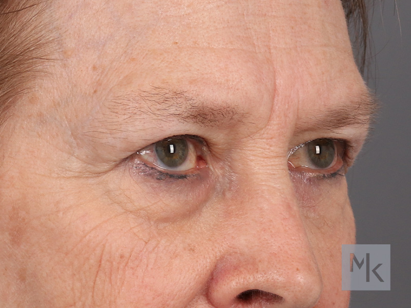 Lower Blepharoplasty Before and After | Dr. Michael Kim