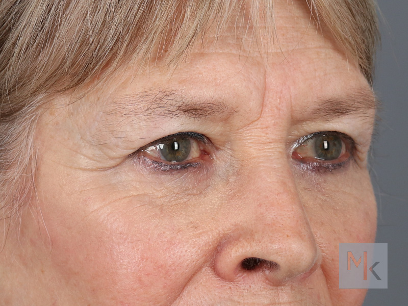 Lower Blepharoplasty Before and After | Dr. Michael Kim