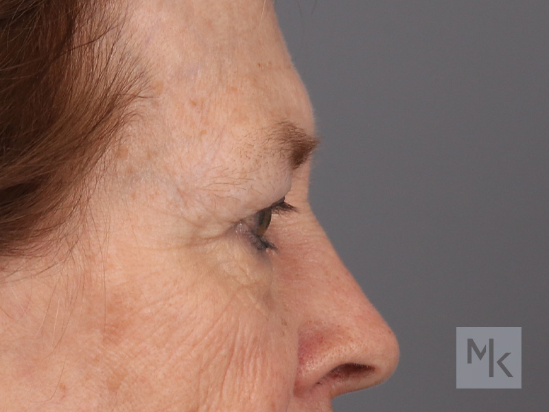 Lower Blepharoplasty Before and After | Dr. Michael Kim