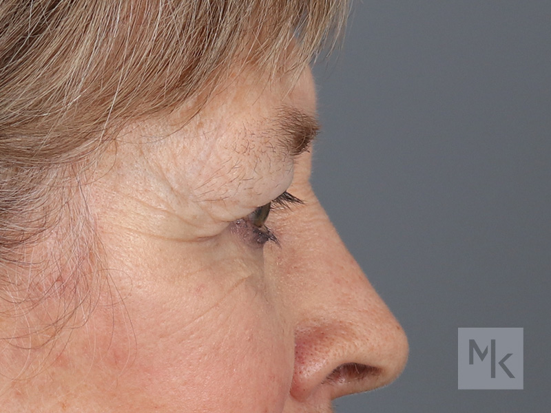 Lower Blepharoplasty Before and After | Dr. Michael Kim