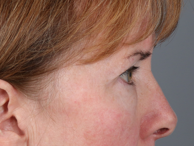 Lower Blepharoplasty Before and After | Dr. Michael Kim