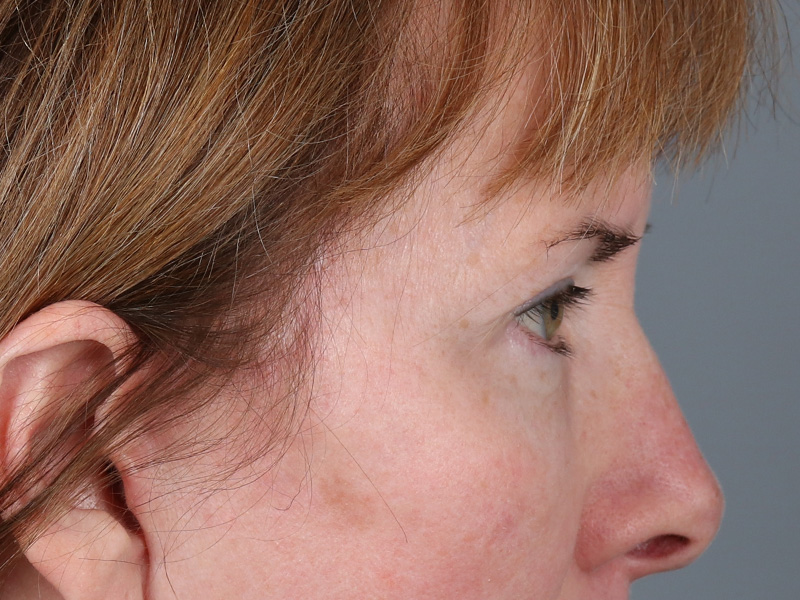 Lower Blepharoplasty Before and After | Dr. Michael Kim