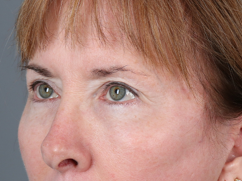 Lower Blepharoplasty Before and After | Dr. Michael Kim