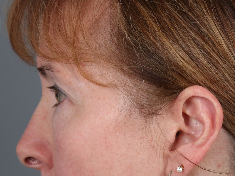 Lower Blepharoplasty Before and After | Dr. Michael Kim