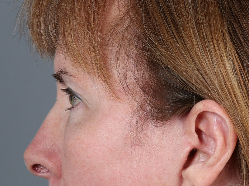 Lower Blepharoplasty Before and After | Dr. Michael Kim