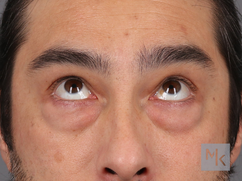 Lower Blepharoplasty Before and After | Dr. Michael Kim